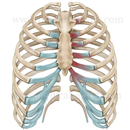 10 best images about Costochondritis on Pinterest