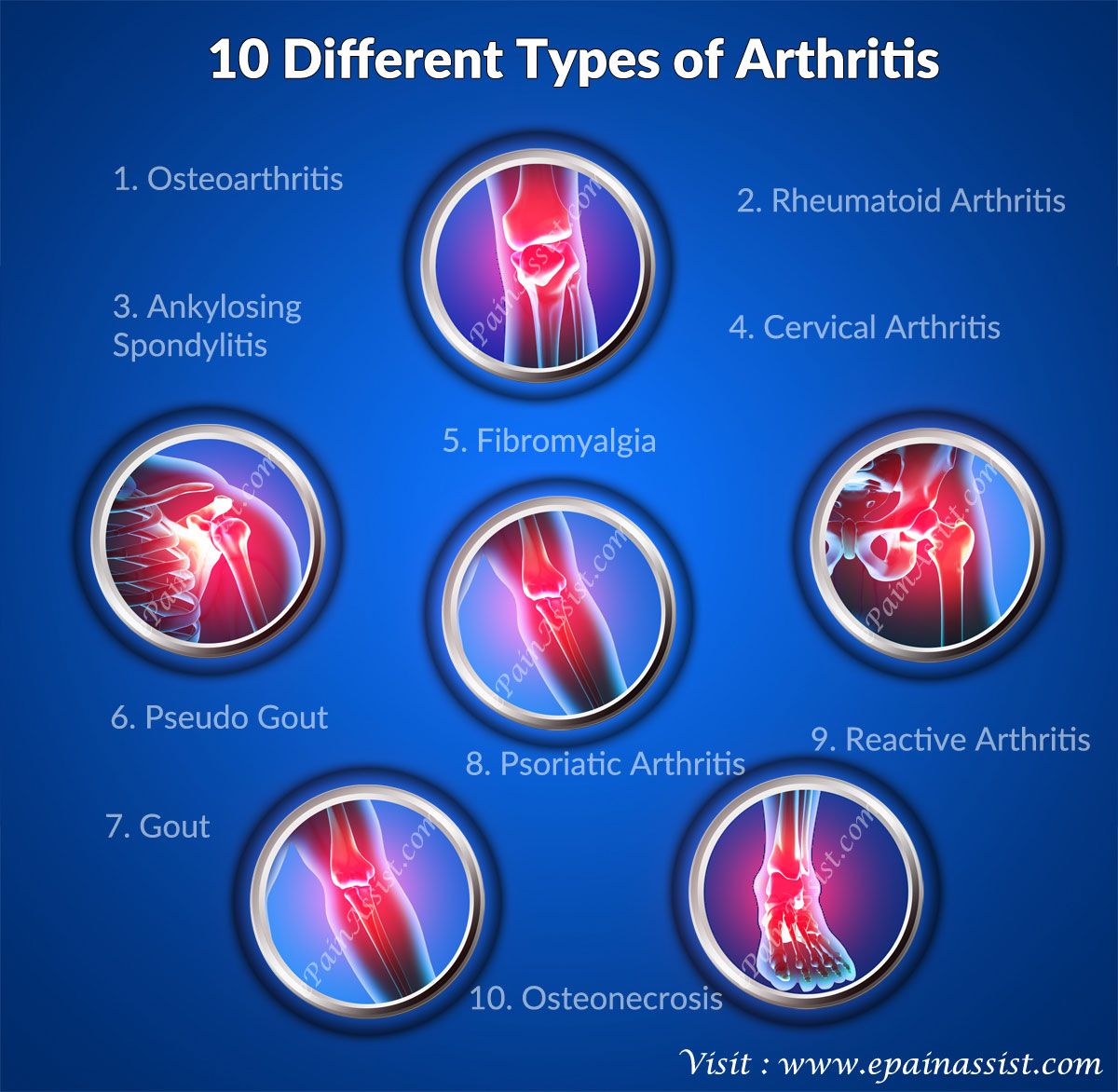 10 Different Types of Arthritis
