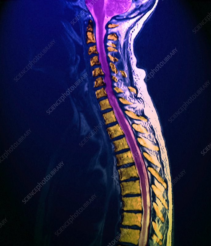 Arthritis of the spine, MRI scan