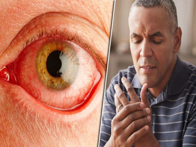 Can Rheumatoid Arthritis Affect Your Eyesight