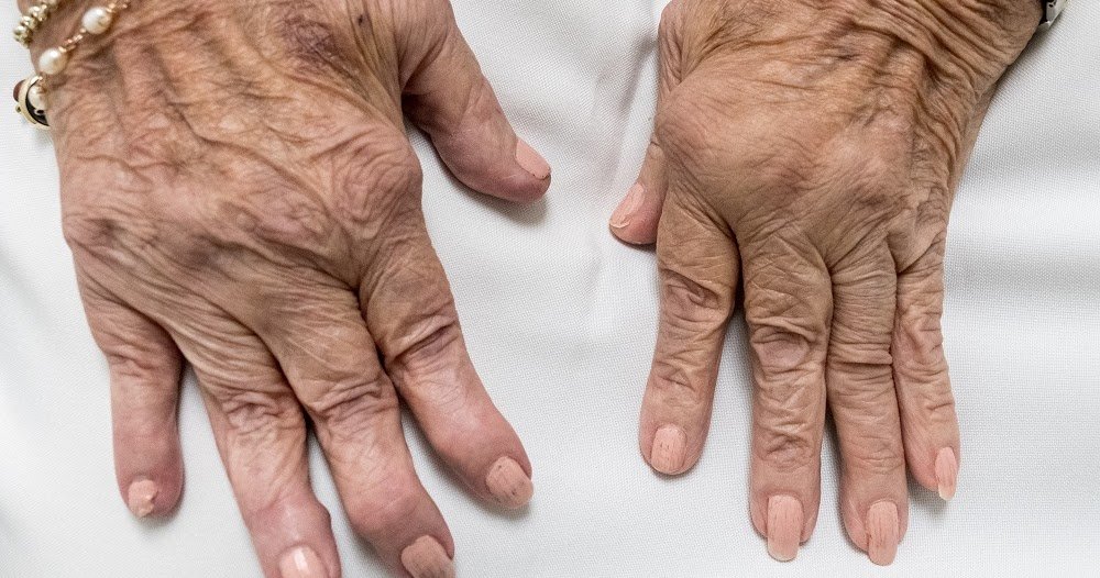 CAN YOU DIE FROM RHEUMATOID ARTHRITIS(RA)?