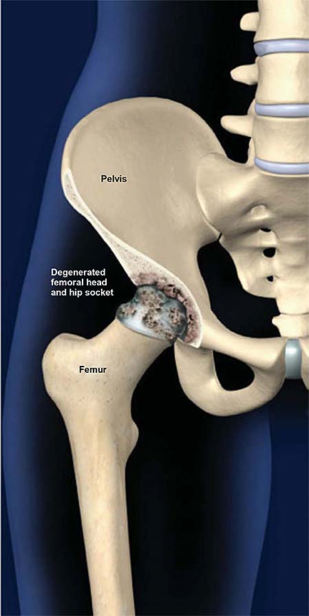 Degenerative Joint Disease of the Hip (Osteoarthritis of the Hip ...