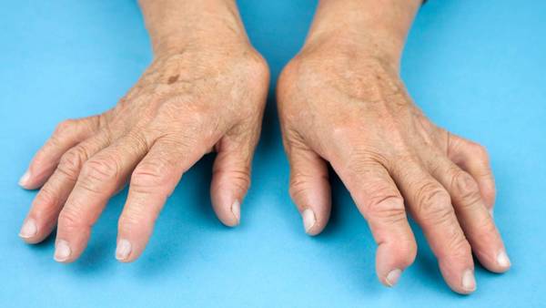Expert explains: How do you spell rheumatoid arthritis ...