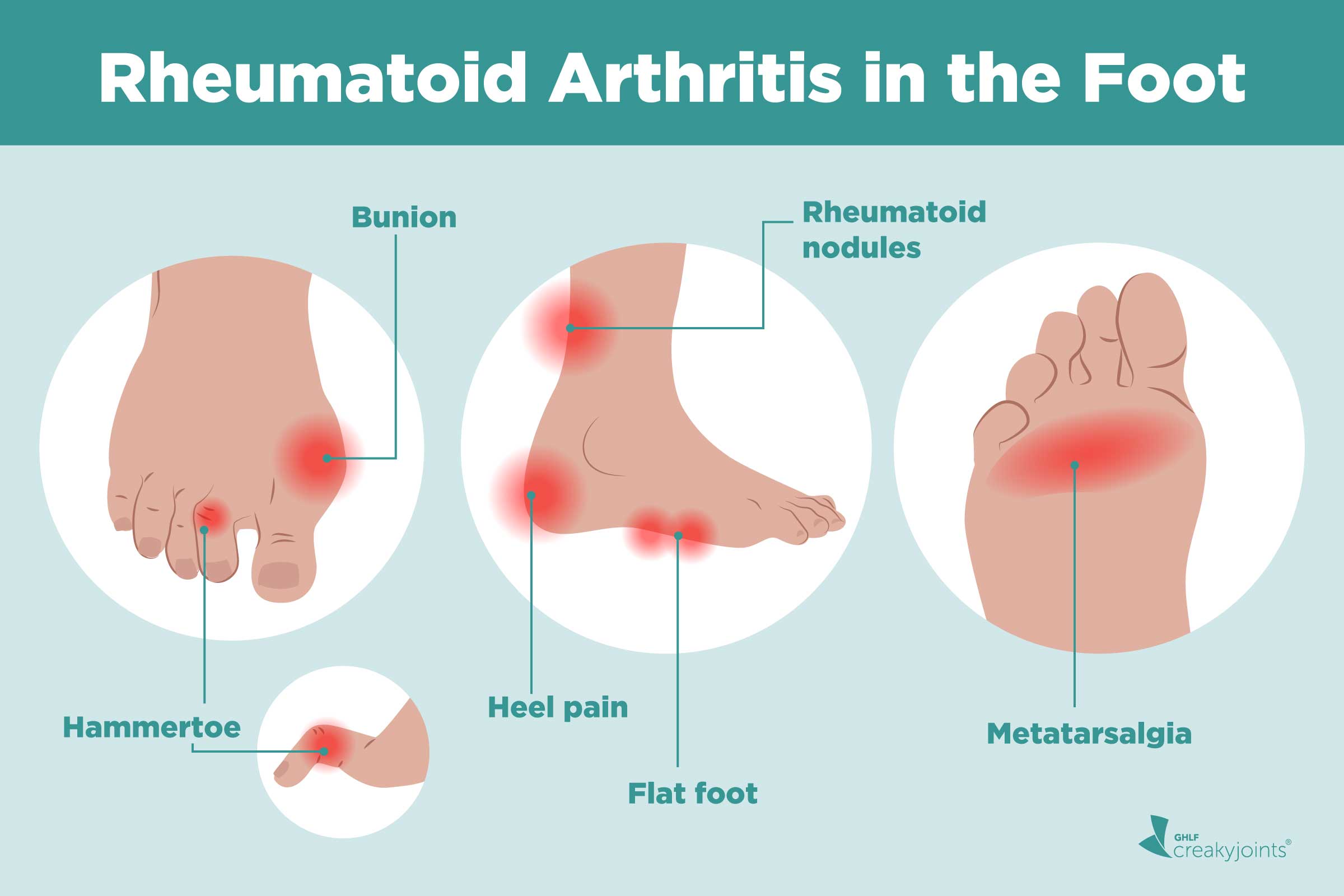 Get Is Rheumatoid Arthritis Painful Images