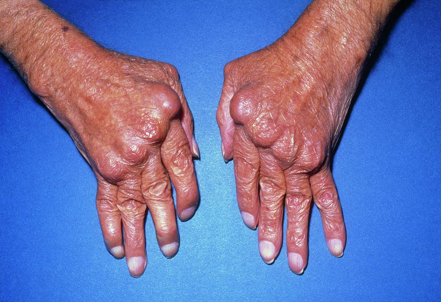 Hands With Rheumatoid Arthritis Photograph by James ...
