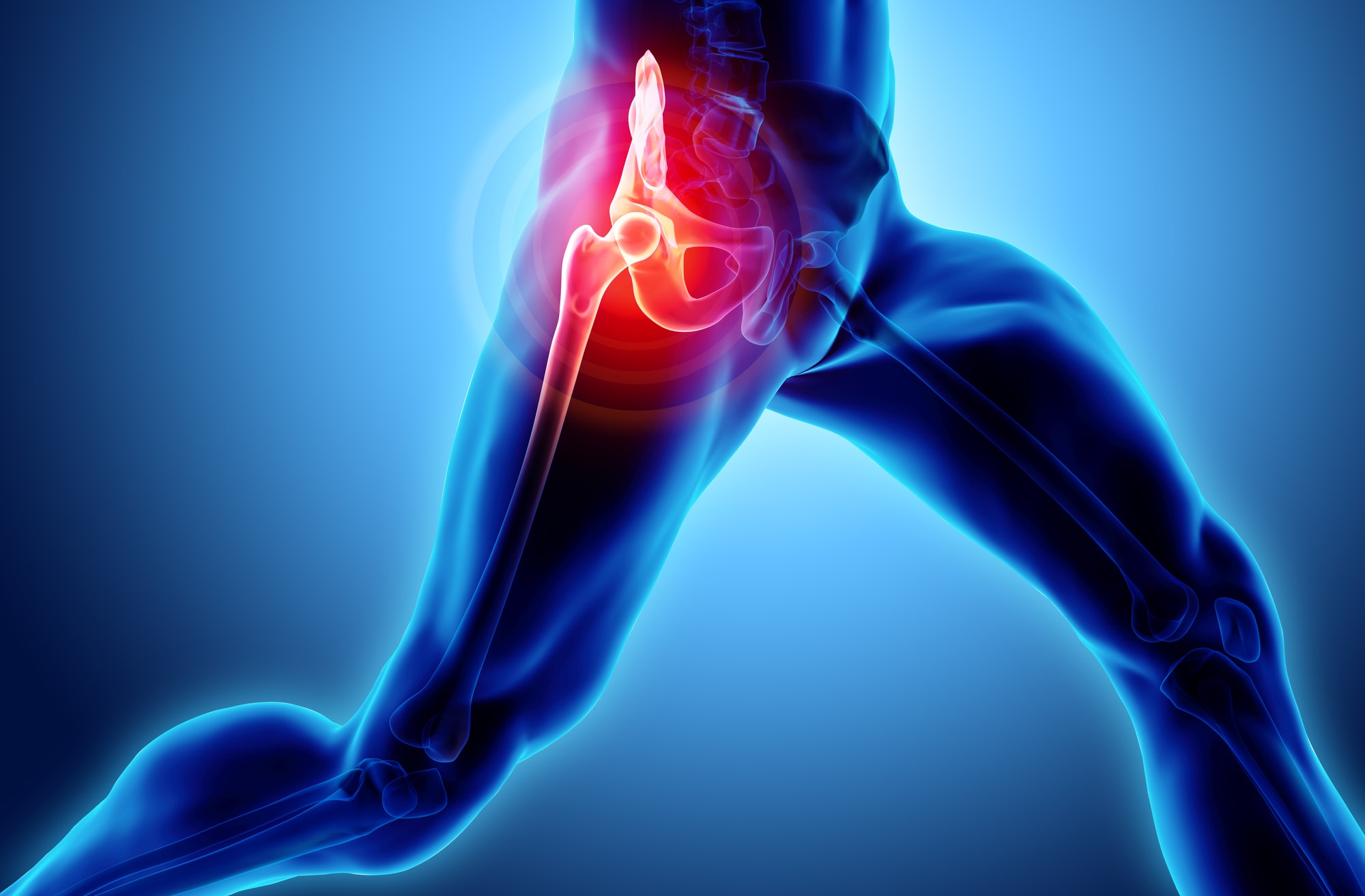Hip Replacement Surgery: Reasons, Type, and Risks Involved ...