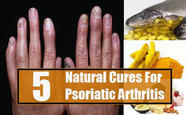 Home remedies for psoriatic arthritis