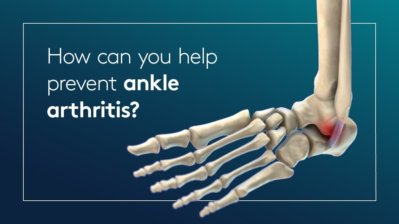 How can you help prevent ankle arthritis?