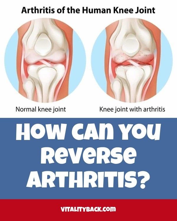 How can you reverse arthritis? Check the webpage to learn ...