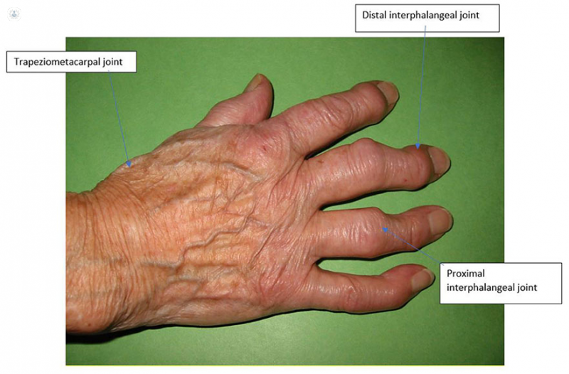 How to manage hand arthritis pain