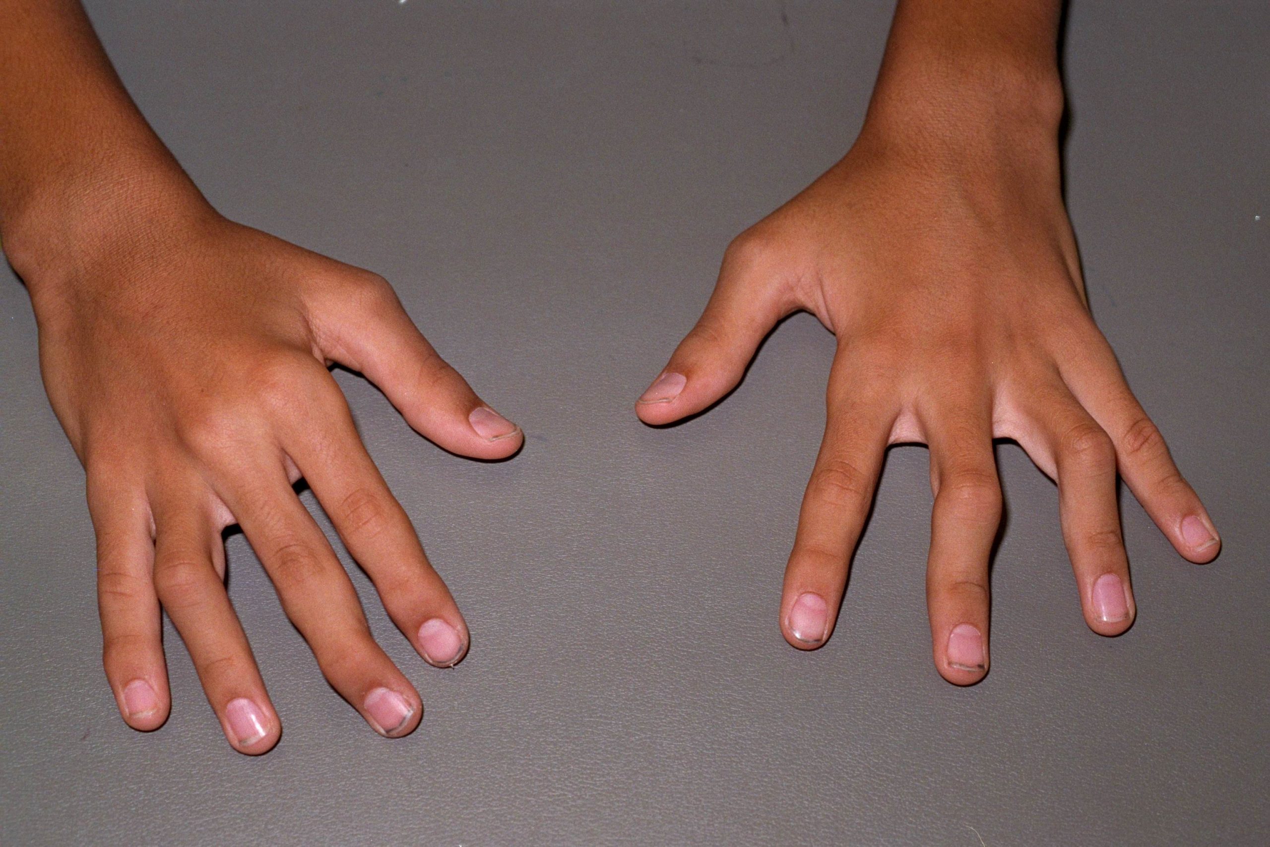 Juvenile Idiopathic Arthritis (Juvenile Rheumatoid ...