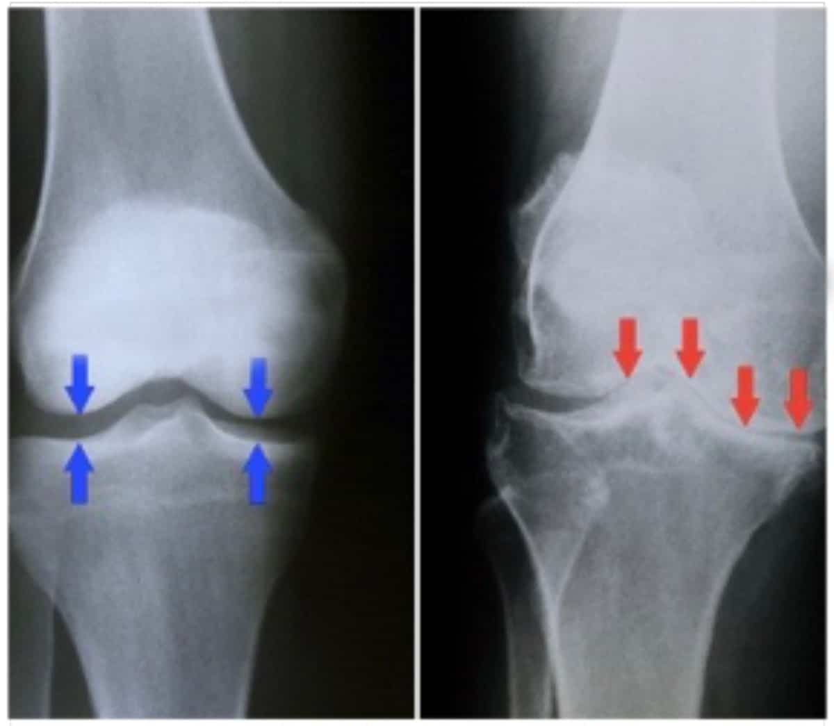 Knee Arthritis In Your 30s Infection Rheumatoid Trigger