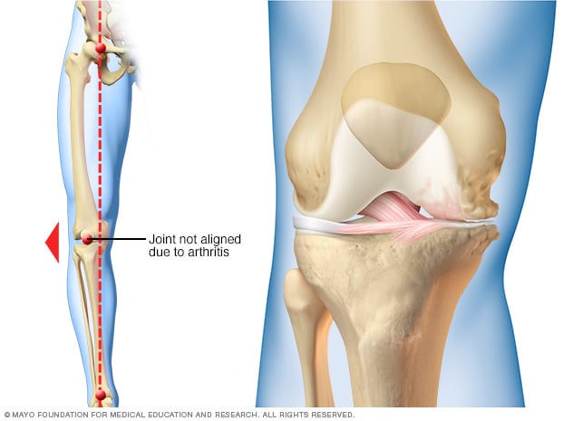 Knee braces for osteoarthritis