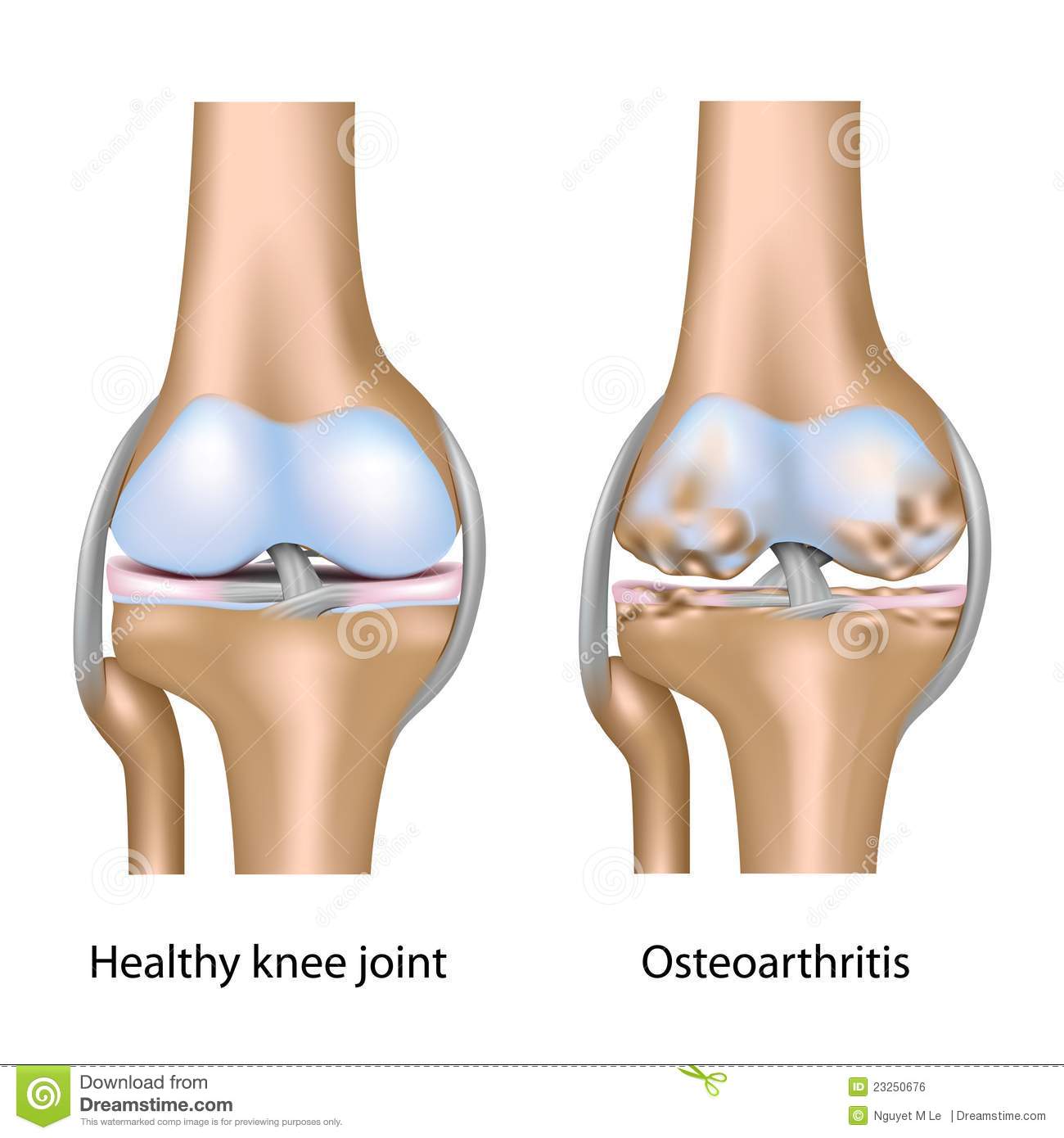 Osteoarthritis Of Knee Joint Stock Vector