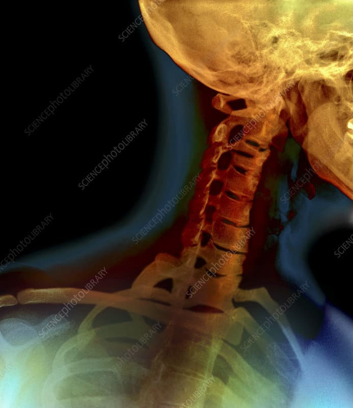 Osteoarthritis of the neck, X