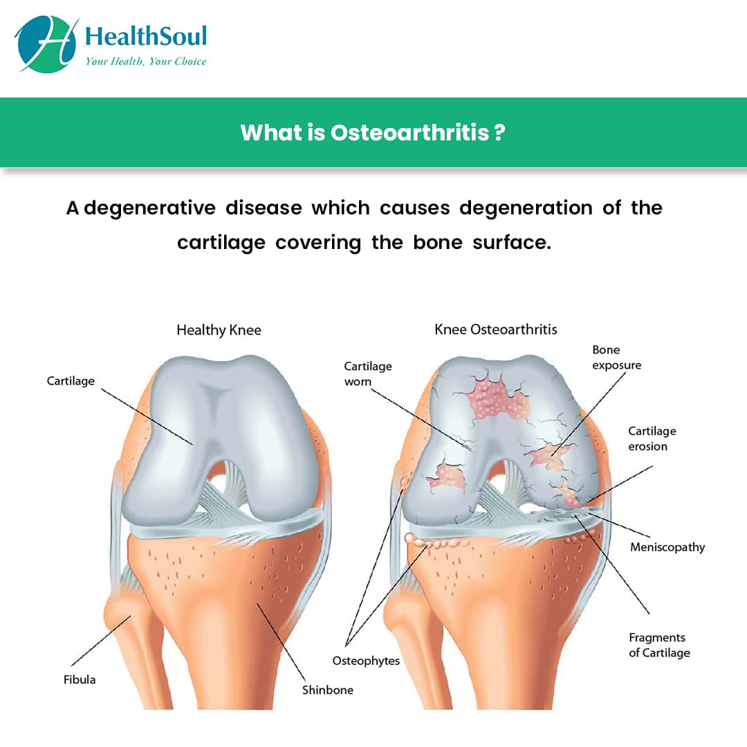 Osteoarthritis: Symptoms, Diagnosis and Treatment  Healthsoul