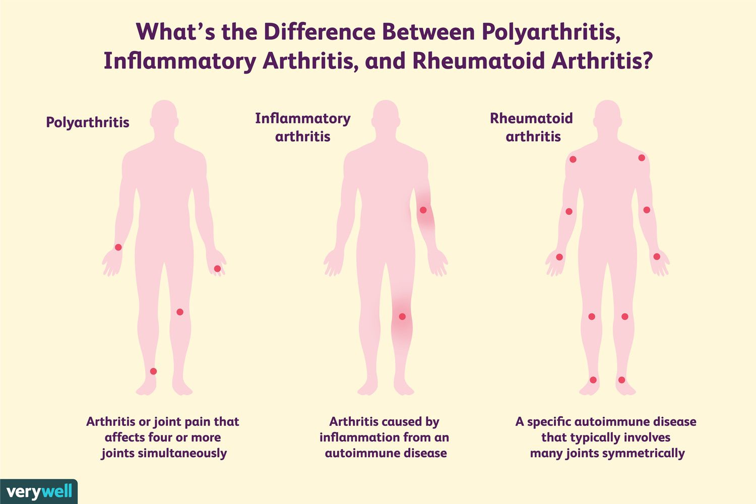 Polyarthritis, Inflammatory Arthritis, and Rheumatoid ...