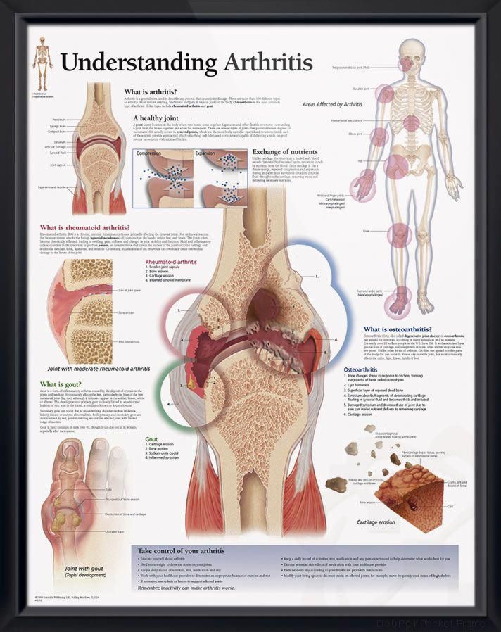 Poster details joints affected by painful Osteoarthritis ...
