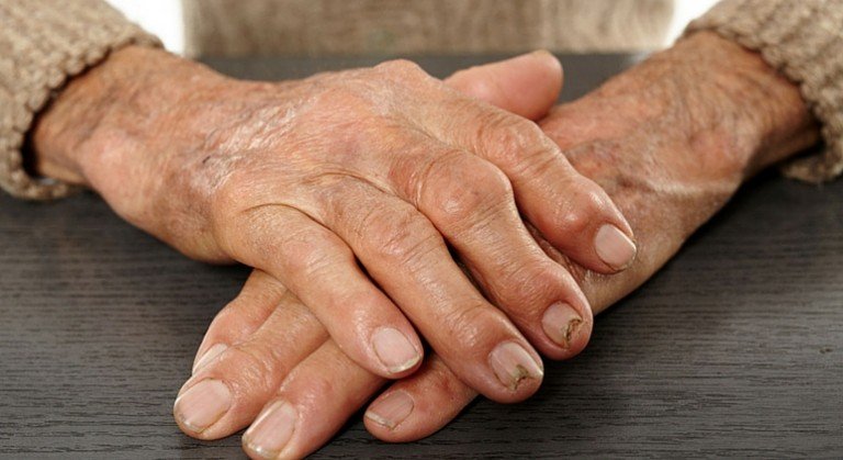 Researchers Link Rheumatoid Arthritis To Gut Bacteria