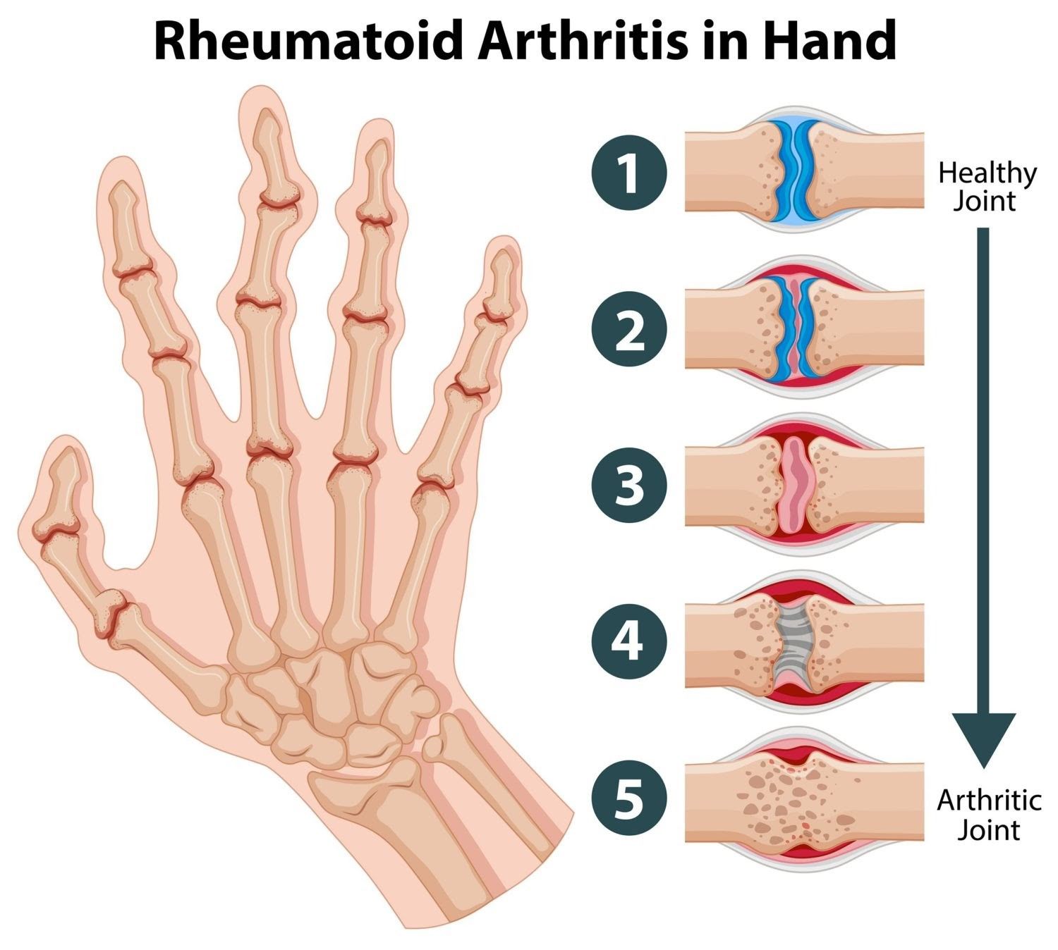Rheumatoid Arthritis (Amavata)
