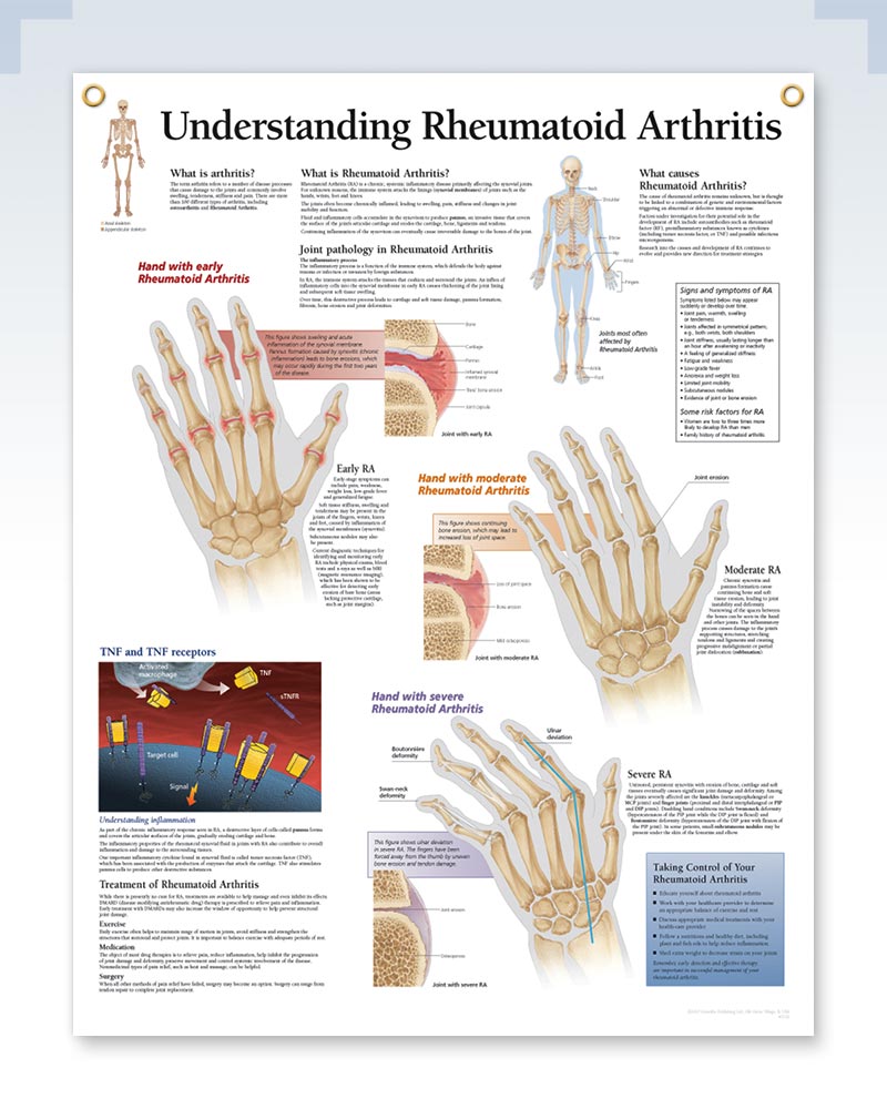 Rheumatoid Arthritis Exam