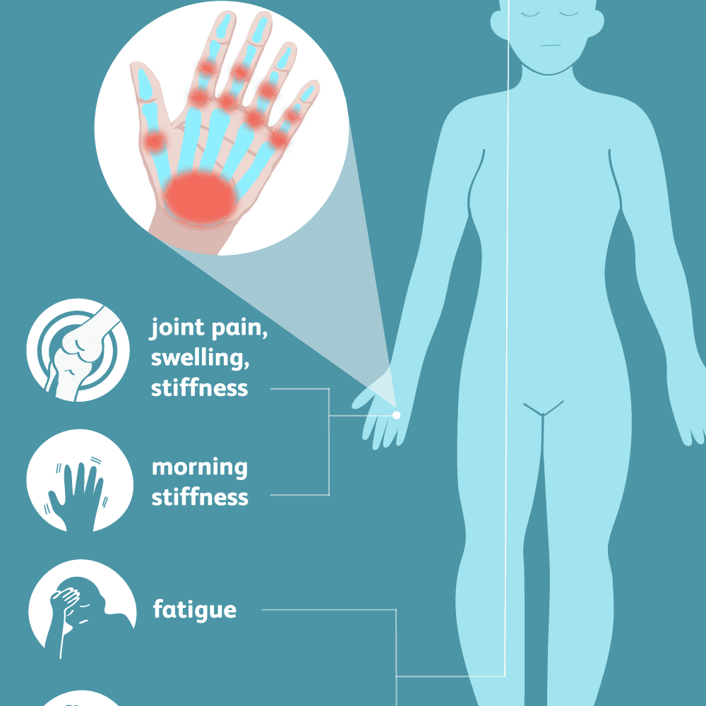 Rheumatoid Arthritis: Signs, Symptoms, and Complications