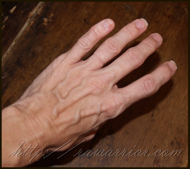 Thinking about Rheumatoid Arthritis Hands