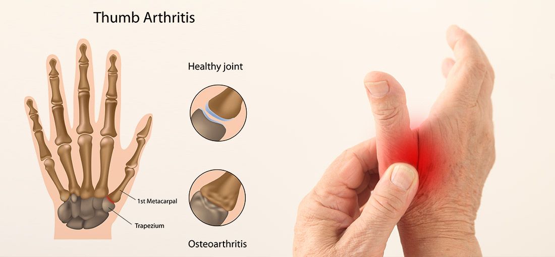 Thumb Arthritis: Get Maximum Comfort With The Right ...