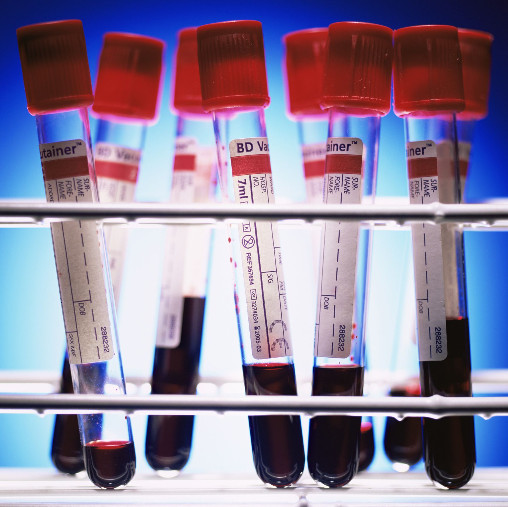 Vectra DA Blood Test for Rheumatoid Arthritis