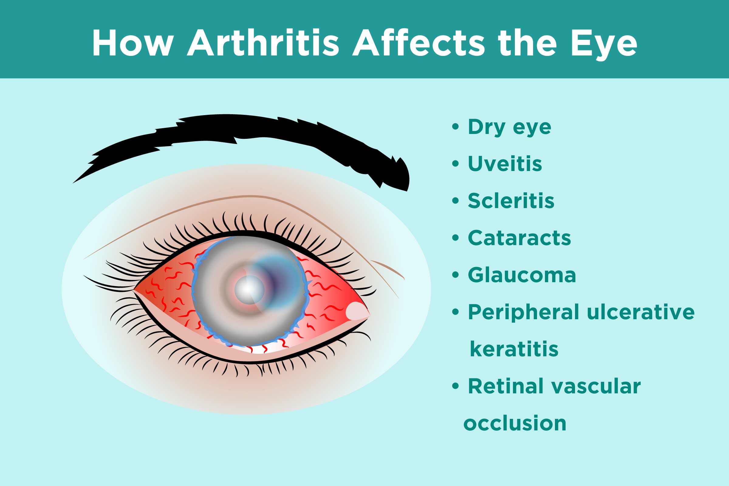 View Arthritis Prevention Pictures