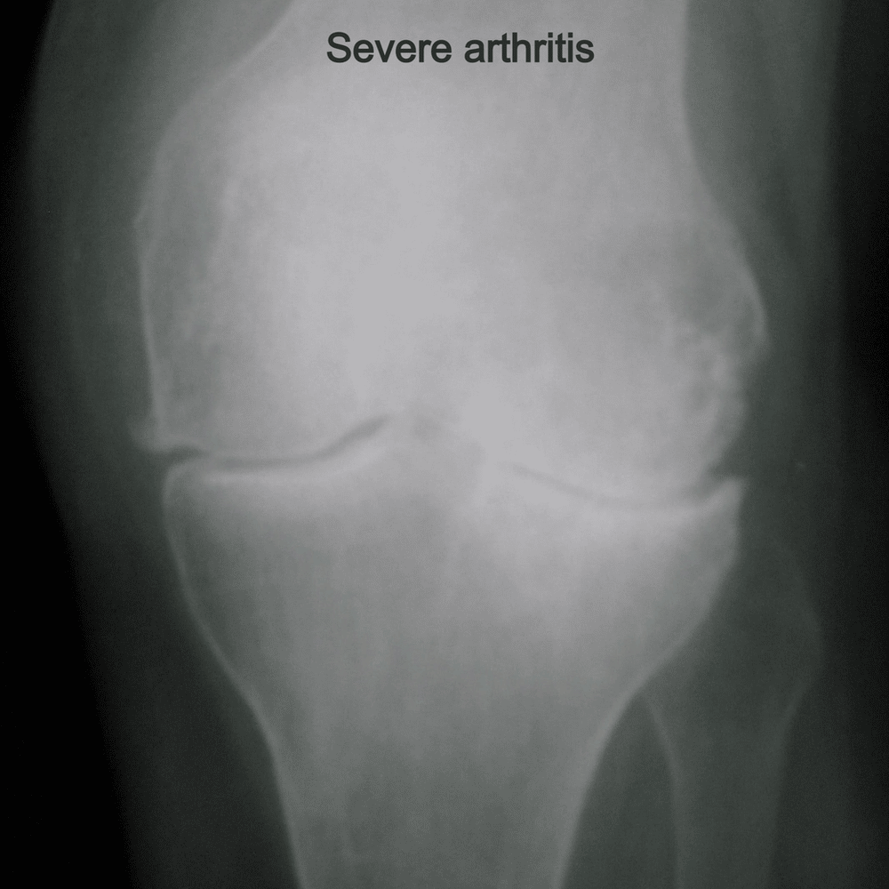 What Does Arthritis Look Like?
