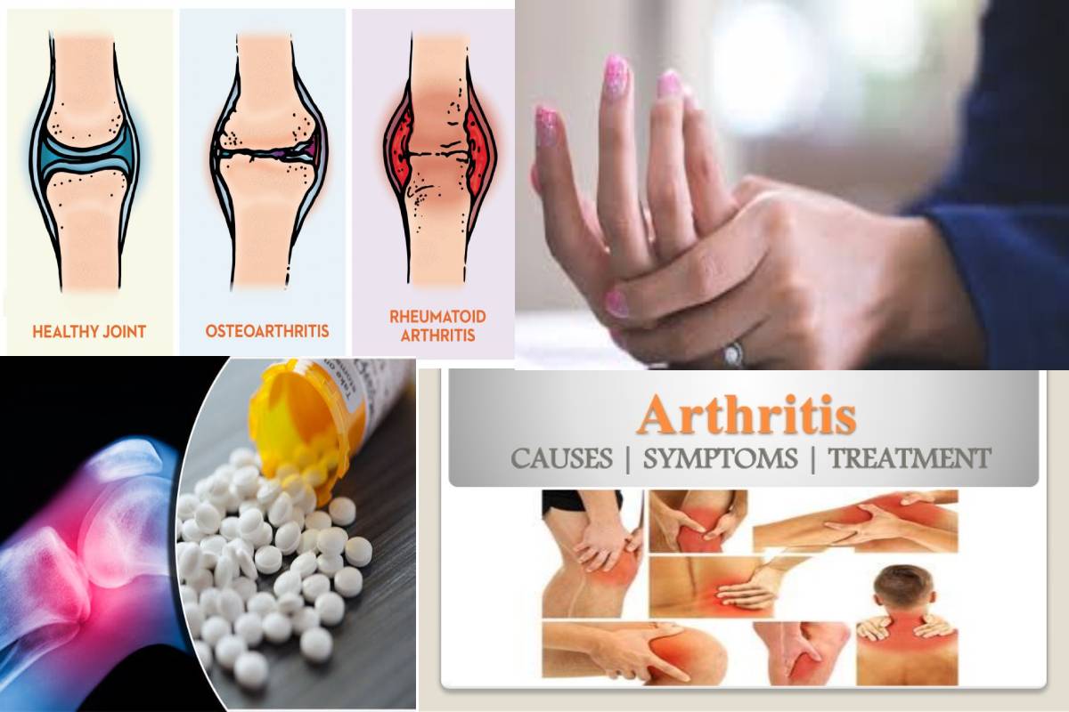 Dieta para artritis reumatoide