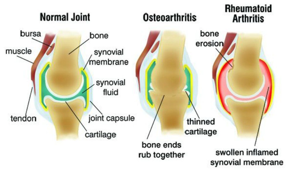 What is Osteoarthritis, Rheumatoid Arthritis, and Gout and ...