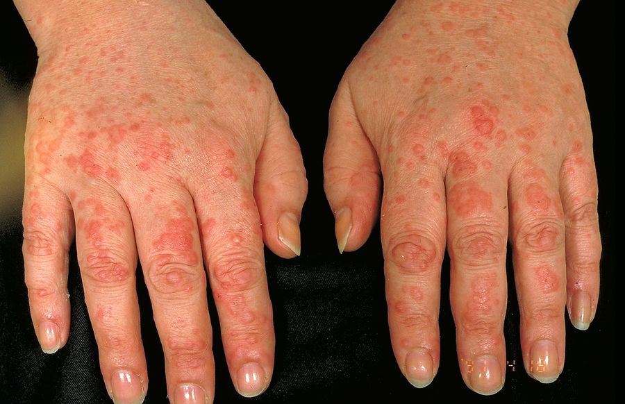 What Skin Problems Does Rheumatoid Arthritis Cause?