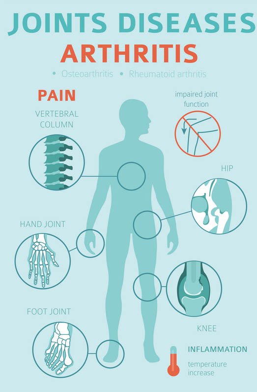 What Triggers Arthritis Flare Ups?  SAPNA Pain Management ...