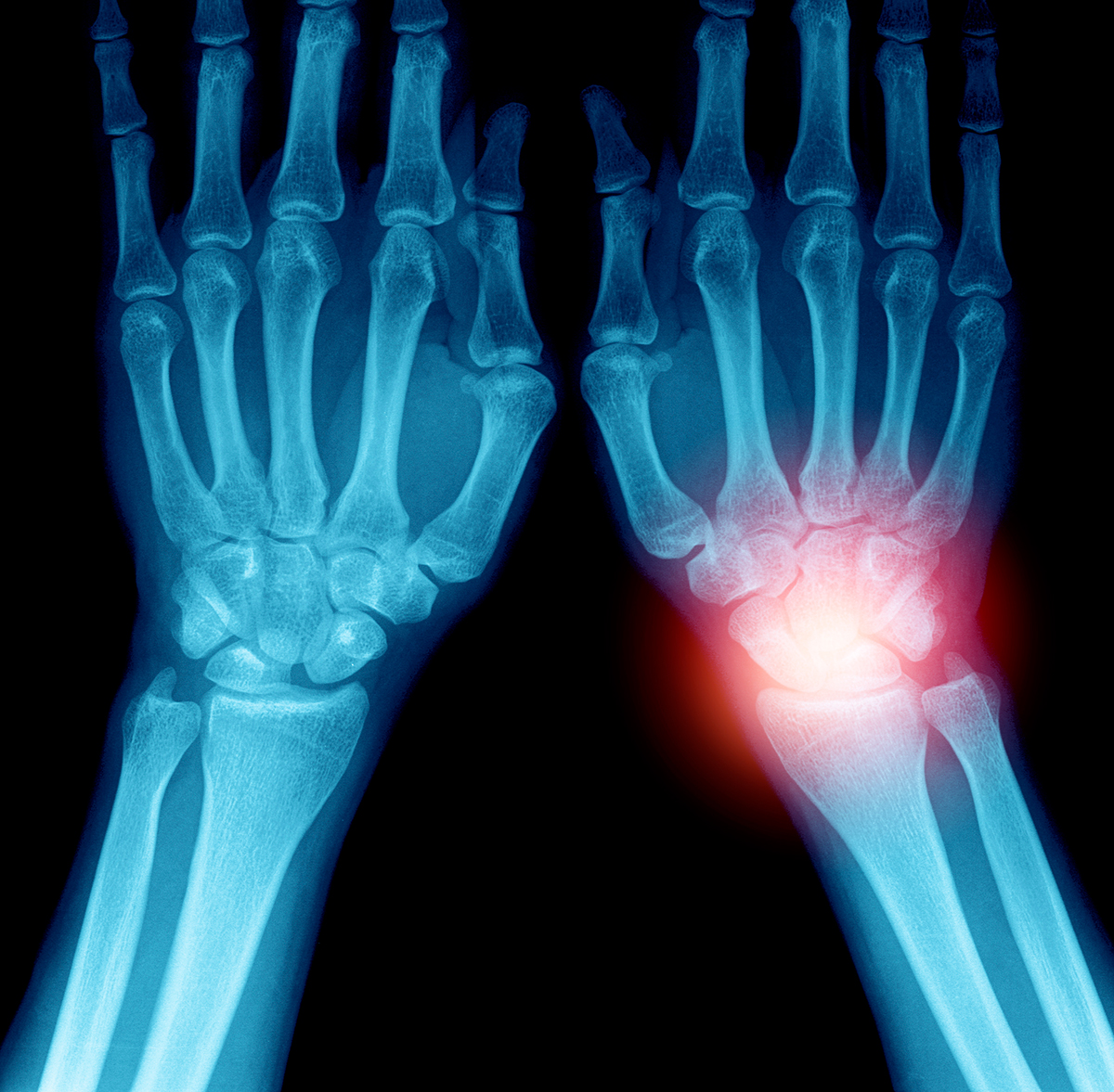 Wrist Pain &  Wrist Arthritis